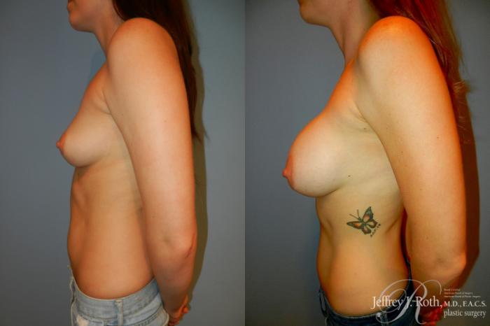 Before & After Breast Augmentation Case 194 Left Side View in Las Vegas and Henderson, NV