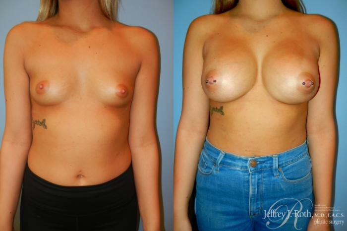 Before & After Breast Augmentation Case 195 Front View in Las Vegas and Henderson, NV