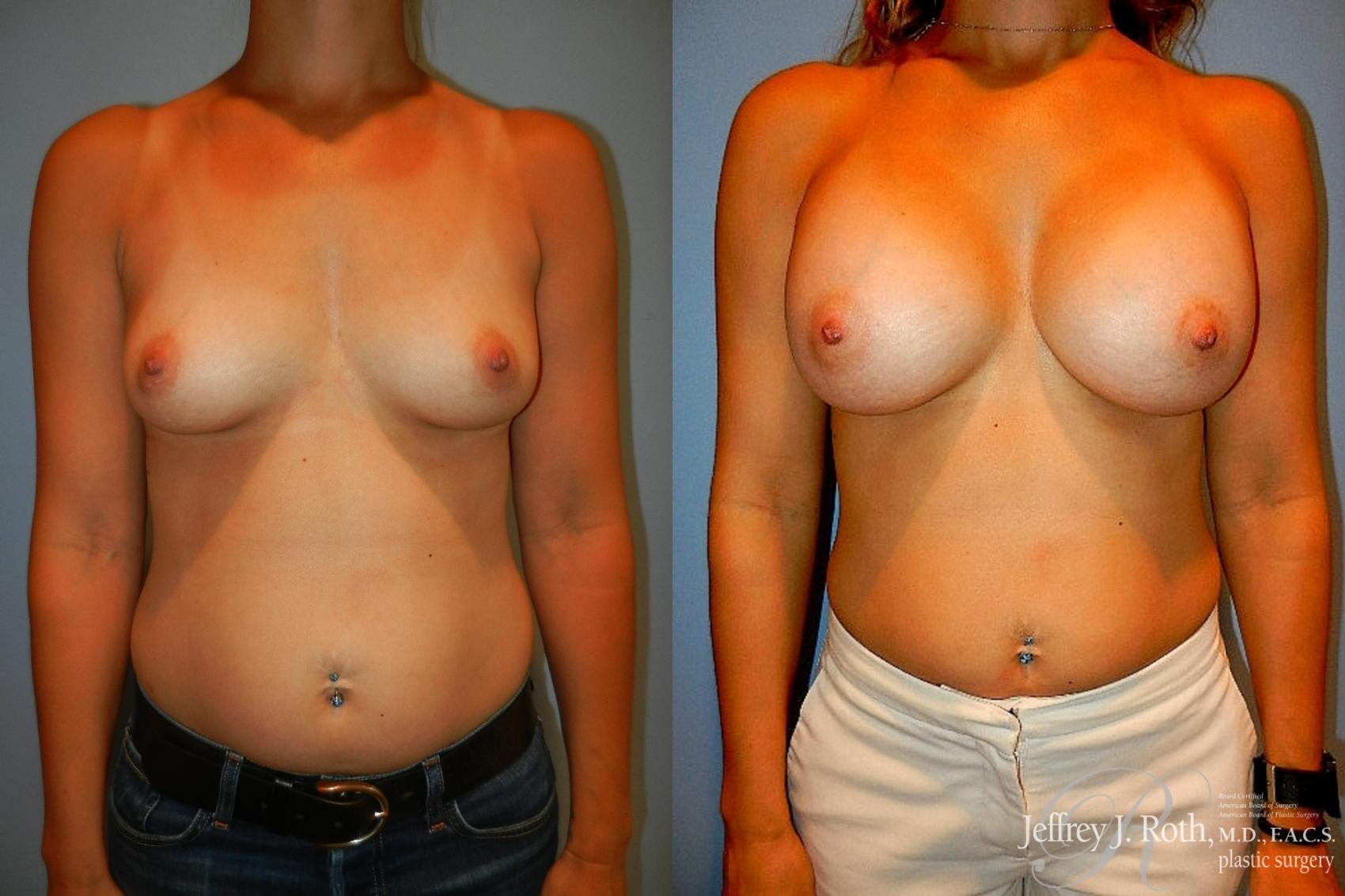 Before & After Breast Augmentation Case 196 Front View in Las Vegas, NV