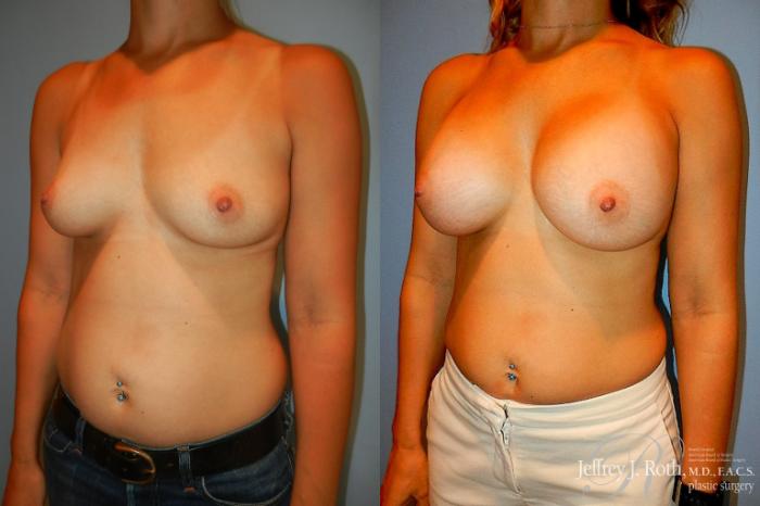 Before & After Breast Augmentation Case 196 Left Oblique View in Las Vegas and Henderson, NV