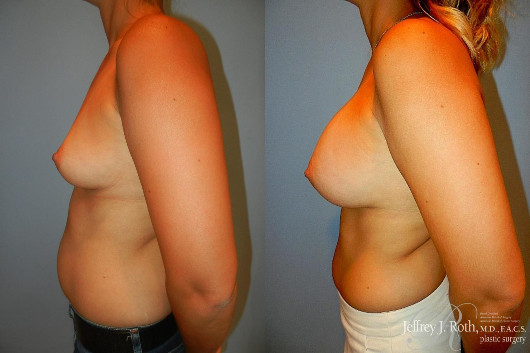 Before & After Breast Augmentation Case 196 Left Side View in Las Vegas, NV