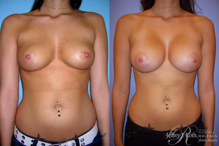 Before & After Breast Augmentation Case 197 Front View in Las Vegas and Henderson, NV