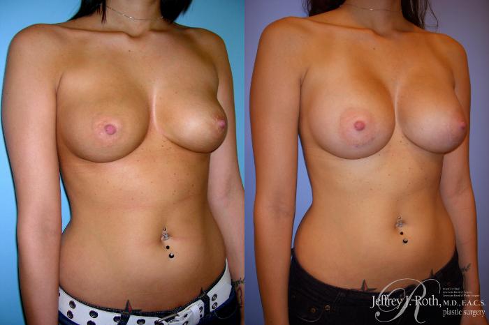 Before & After Breast Augmentation Case 197 Right Oblique View in Las Vegas and Henderson, NV