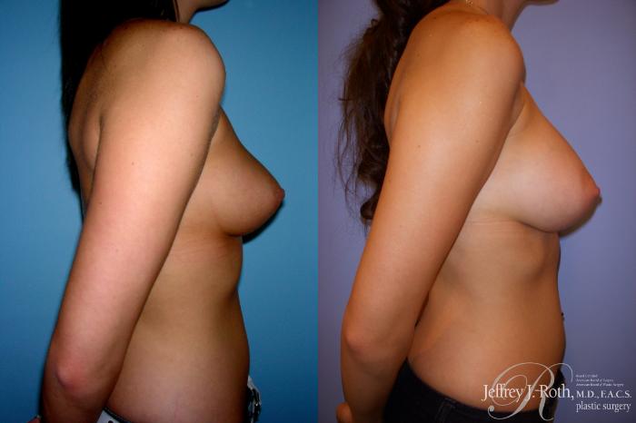 Before & After Breast Augmentation Case 197 Right Side View in Las Vegas and Henderson, NV