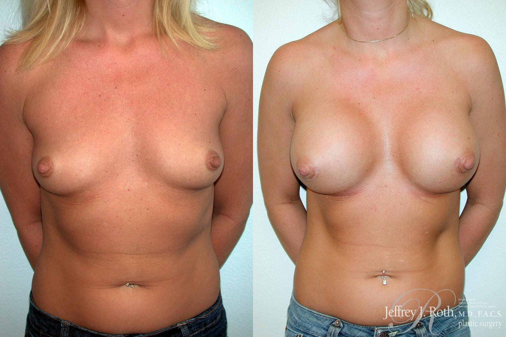 Before & After Breast Augmentation Case 198 Front View in Las Vegas, NV