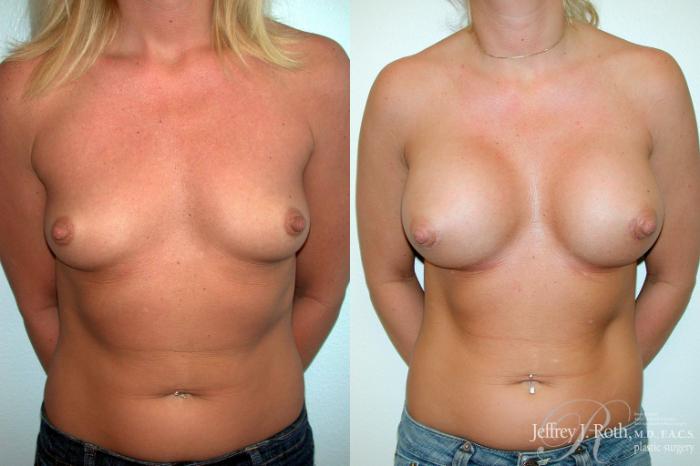 Before & After Breast Augmentation Case 198 Front View in Las Vegas and Henderson, NV