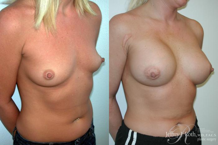 Before & After Breast Augmentation Case 198 Right Oblique View in Las Vegas and Henderson, NV