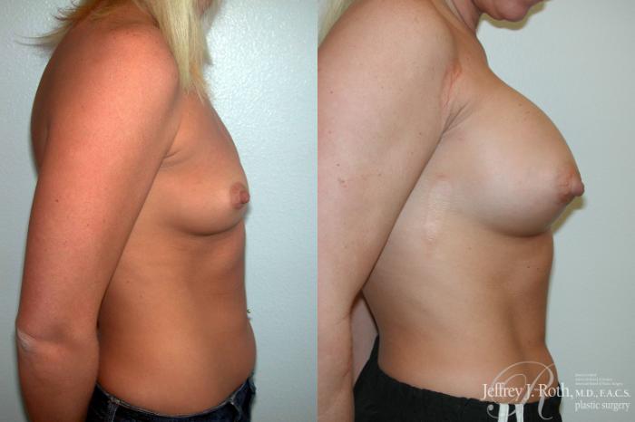 Before & After Breast Augmentation Case 198 Right Side View in Las Vegas and Henderson, NV