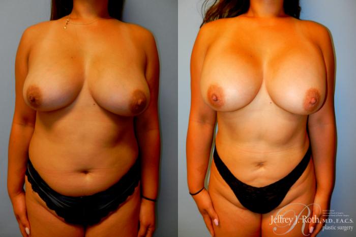 Before & After Breast Augmentation Case 199 Front View in Las Vegas, NV