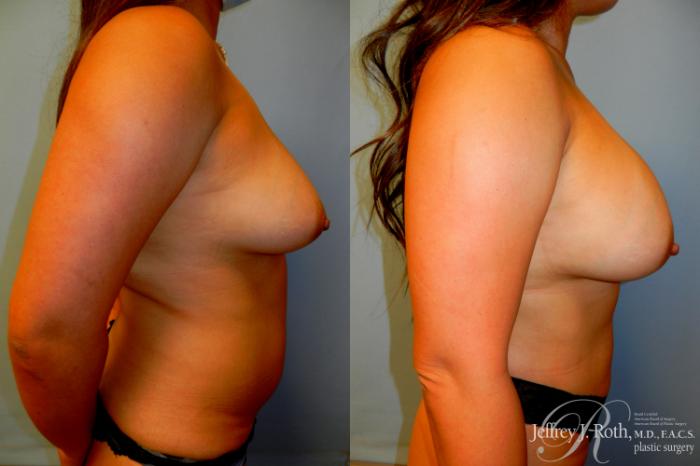 Before & After Breast Augmentation Case 199 Right Side View in Las Vegas and Henderson, NV