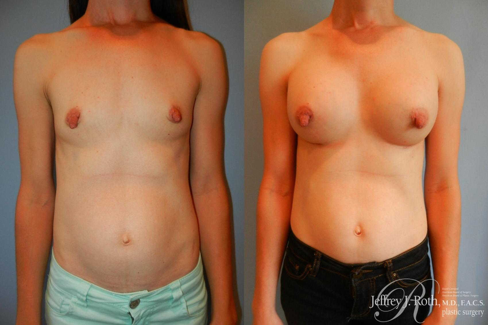 Before & After Breast Augmentation Case 201 Front View in Las Vegas, NV