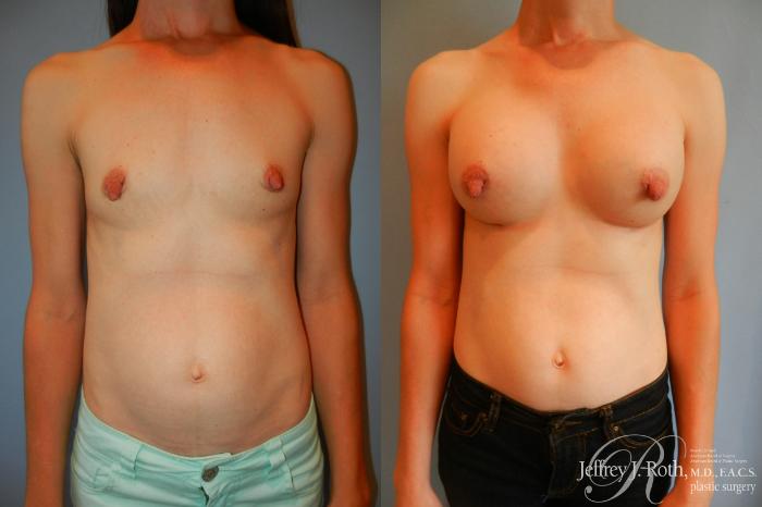 Before & After Breast Augmentation Case 201 Front View in Las Vegas and Henderson, NV