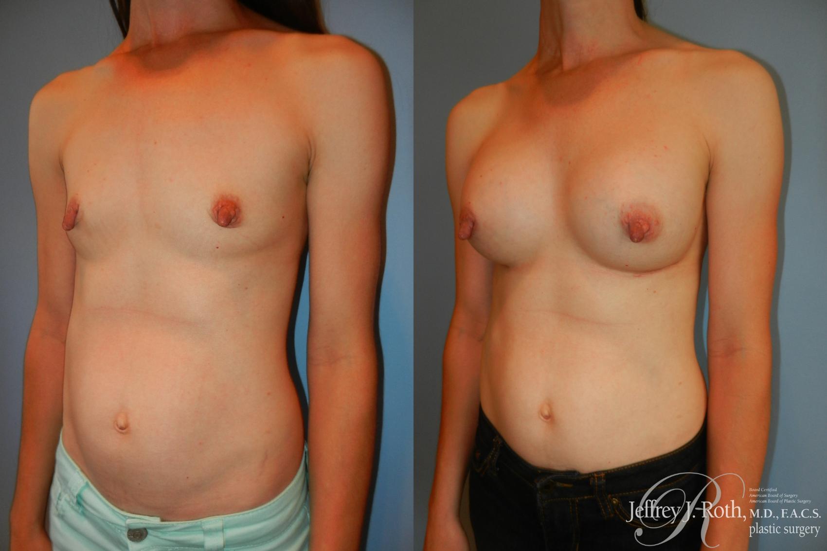 Before & After Breast Augmentation Case 201 Right Oblique View in Las Vegas, NV