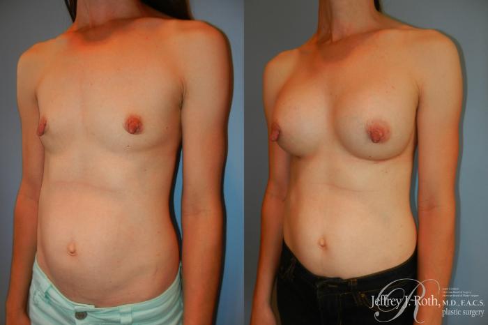 Before & After Breast Augmentation Case 201 Right Oblique View in Las Vegas and Henderson, NV