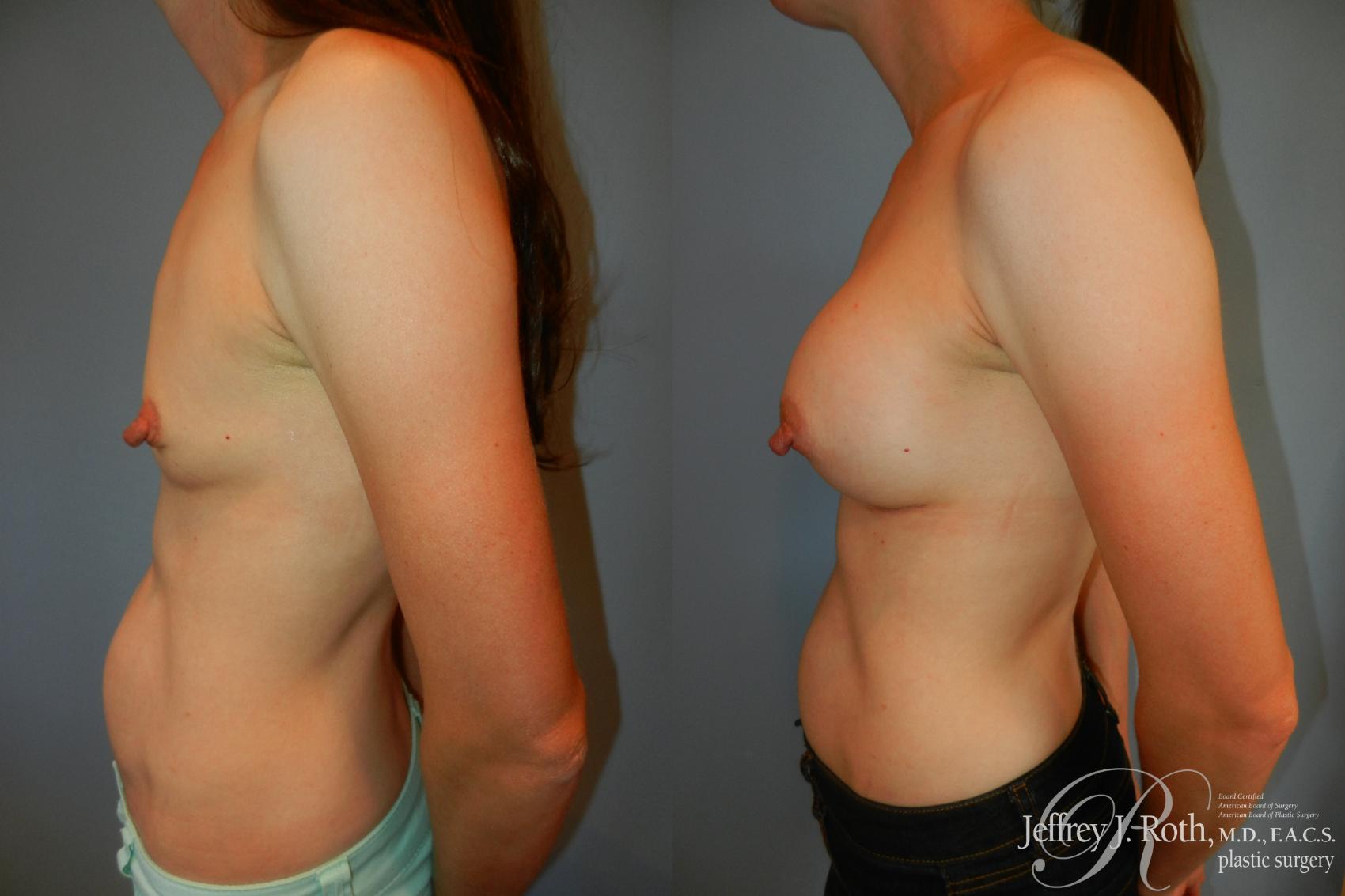 Before & After Breast Augmentation Case 201 Right Side View in Las Vegas, NV