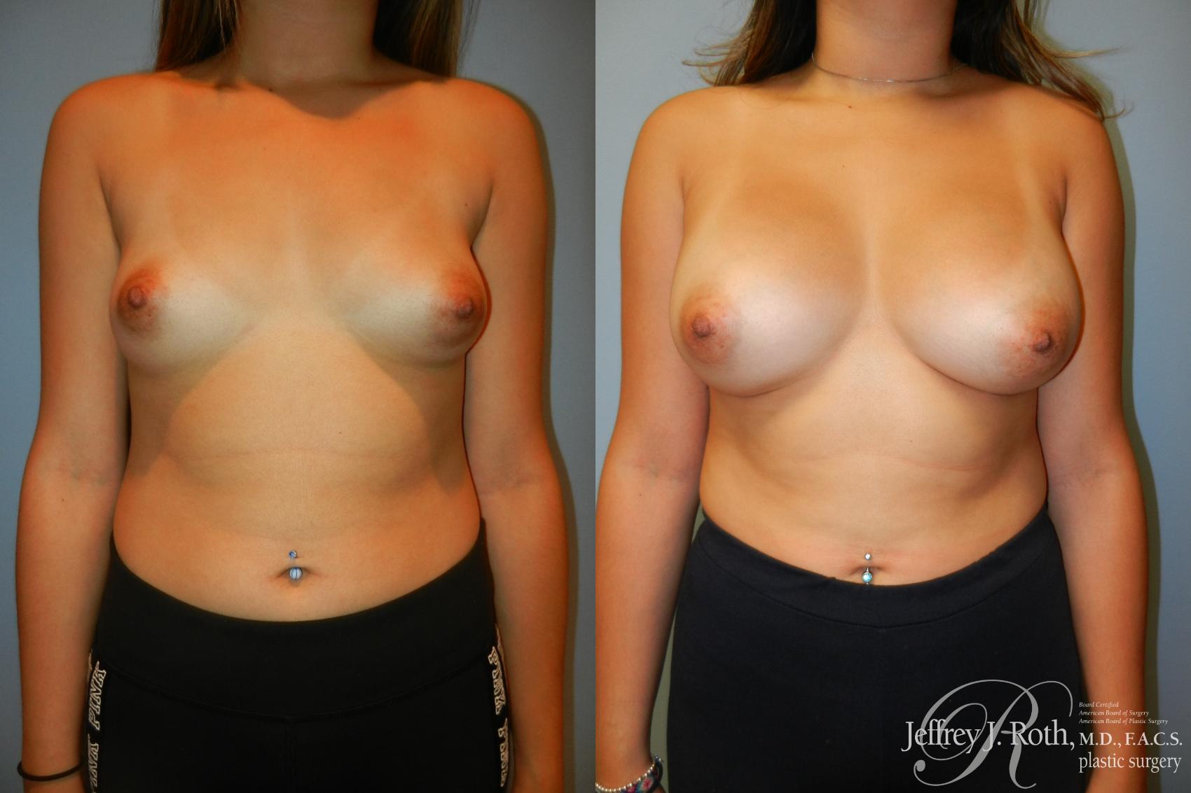 Before & After Breast Augmentation Case 202 Front View in Las Vegas and Henderson, NV