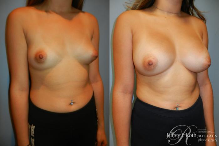 Before & After Breast Augmentation Case 202 Right Oblique View in Las Vegas and Henderson, NV