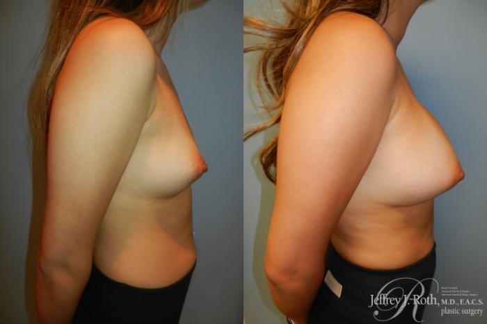 Before & After Breast Augmentation Case 202 Right Side View in Las Vegas and Henderson, NV