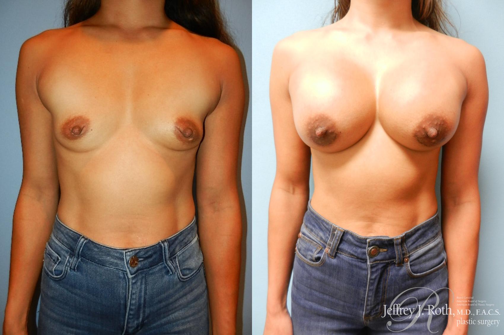Before & After Breast Augmentation Case 205 Front View in Las Vegas, NV