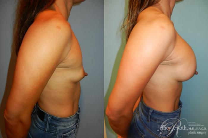 Before & After Breast Augmentation Case 205 Right Side View in Las Vegas and Henderson, NV