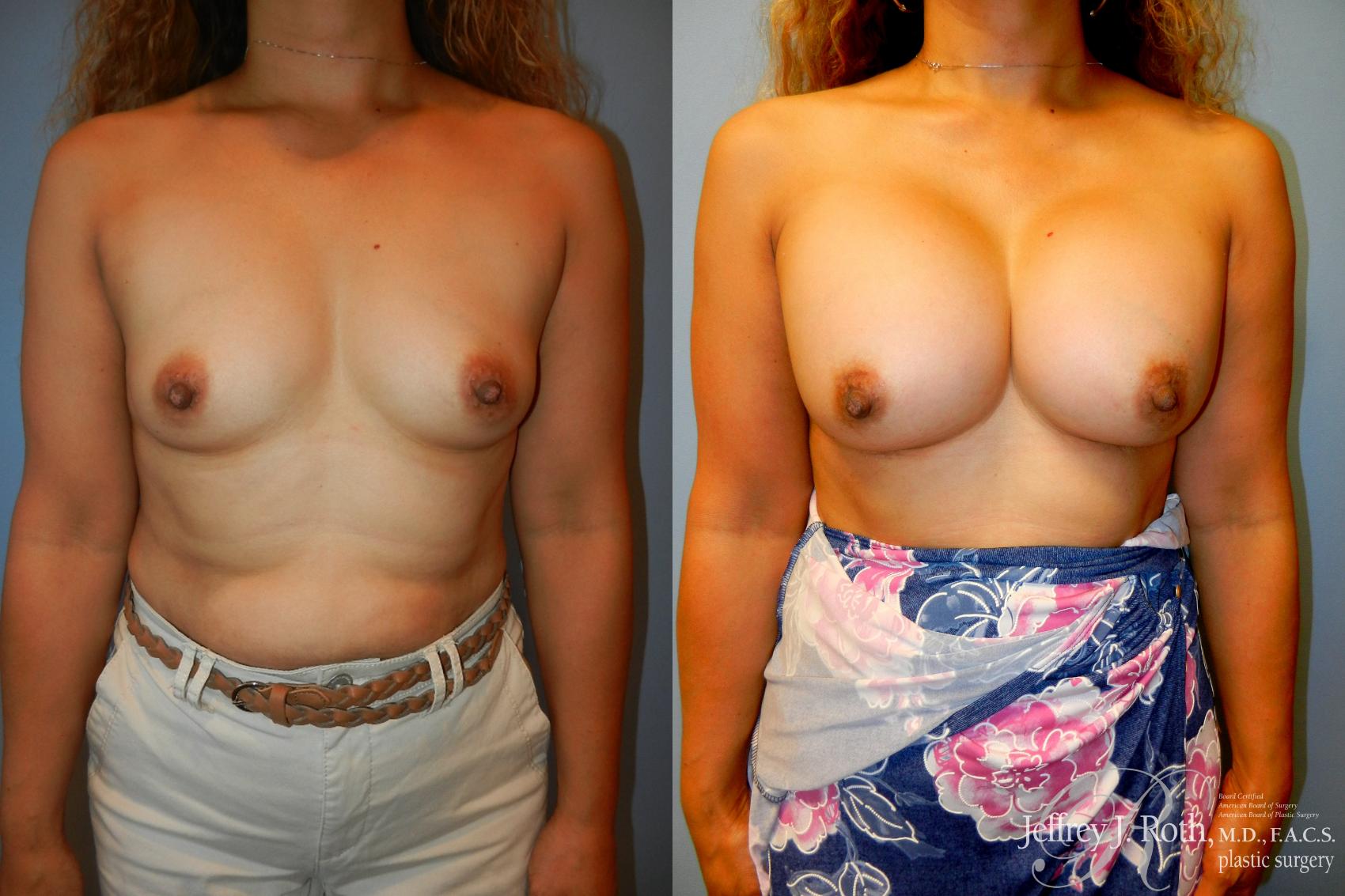 Before & After Breast Augmentation Case 206 Front View in Las Vegas, NV