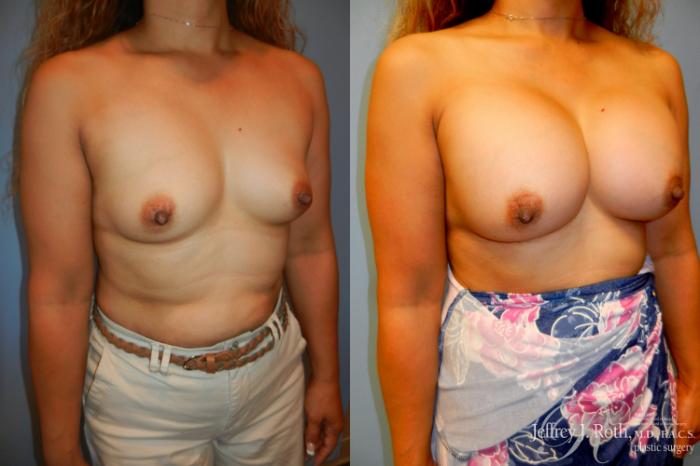 Before & After Breast Augmentation Case 206 Right Oblique View in Las Vegas and Henderson, NV