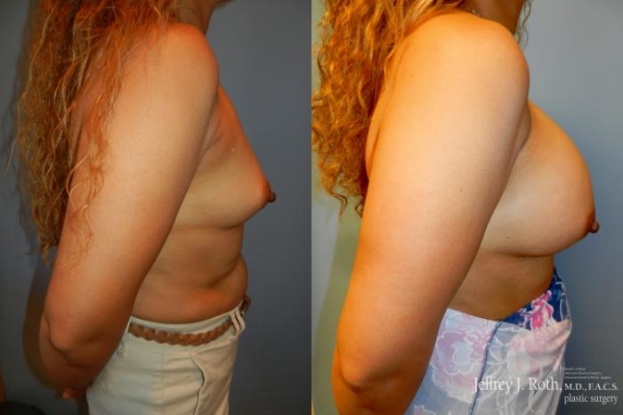 Before & After Breast Augmentation Case 206 Right Side View in Las Vegas and Henderson, NV