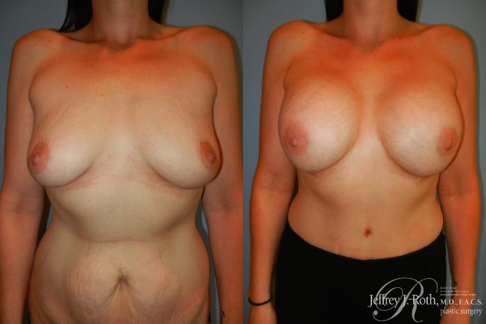 Before & After Breast Augmentation Case 208 Front View in Las Vegas, NV