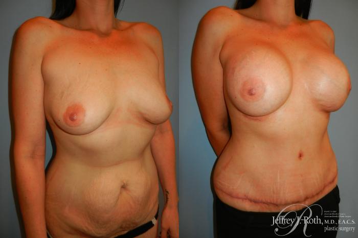 Before & After Breast Augmentation Case 208 Right Oblique View in Las Vegas and Henderson, NV