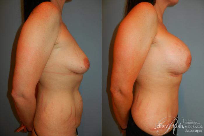 Before & After Breast Augmentation Case 208 Right Side View in Las Vegas and Henderson, NV