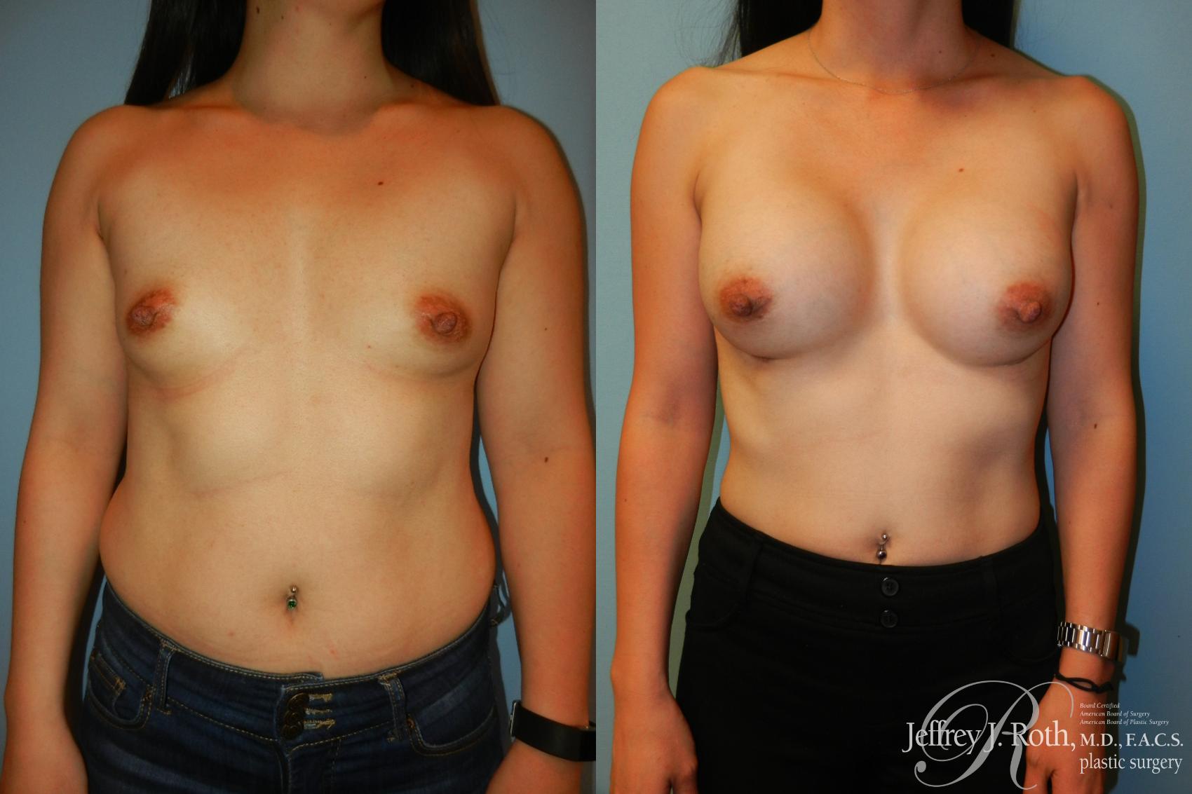 Before & After Breast Augmentation Case 209 Front View in Las Vegas and Henderson, NV