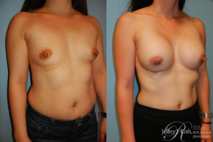 Before & After Breast Augmentation Case 209 Right Oblique View in Las Vegas and Henderson, NV