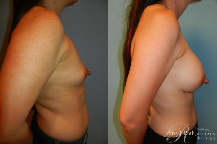 Before & After Breast Augmentation Case 209 Right Side View in Las Vegas and Henderson, NV