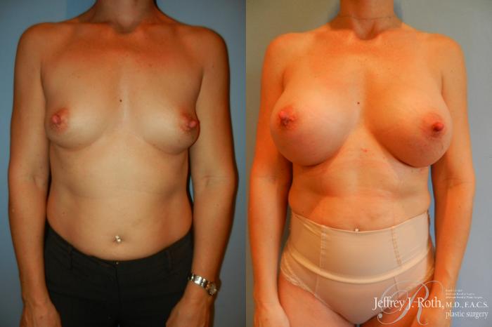 Before & After Breast Augmentation Case 210 Front View in Las Vegas, NV