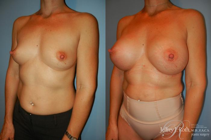Before & After Breast Augmentation Case 210 Left Oblique View in Las Vegas and Henderson, NV