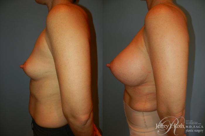 Before & After Breast Augmentation Case 210 Left Side View in Las Vegas and Henderson, NV