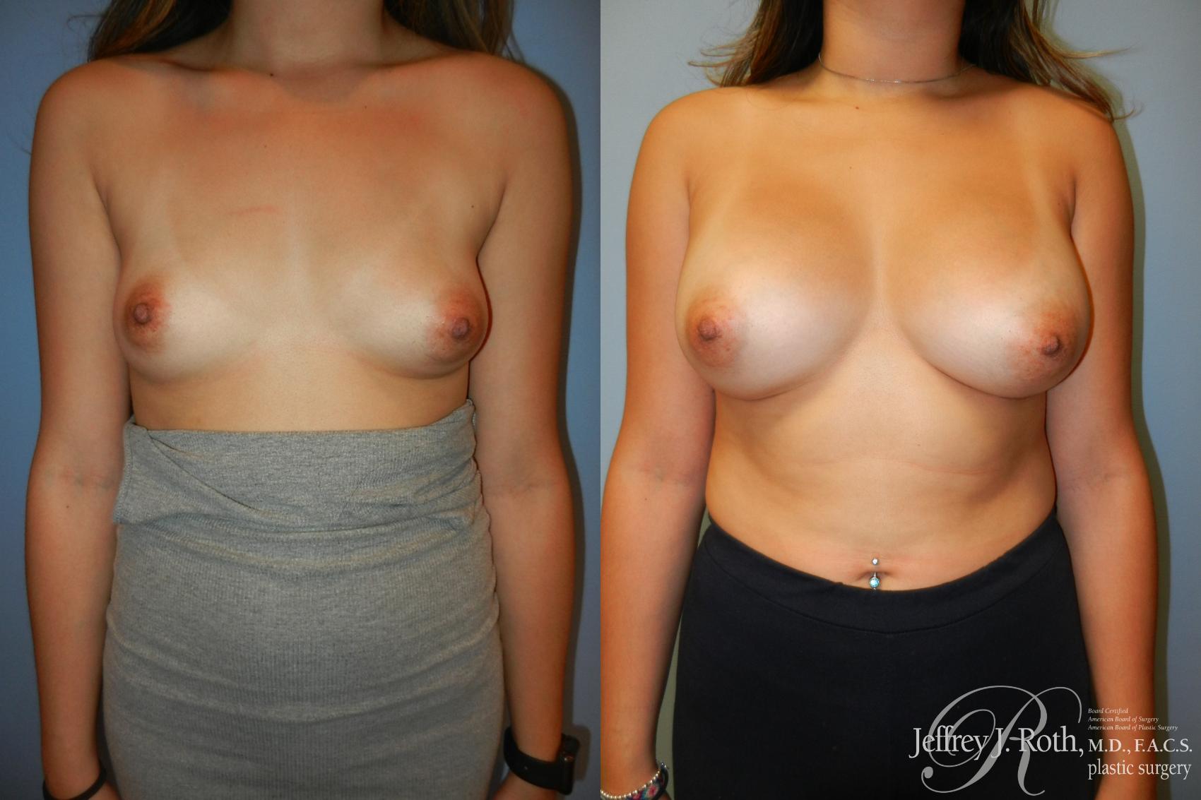 Before & After Breast Augmentation Case 211 Front View in Las Vegas, NV