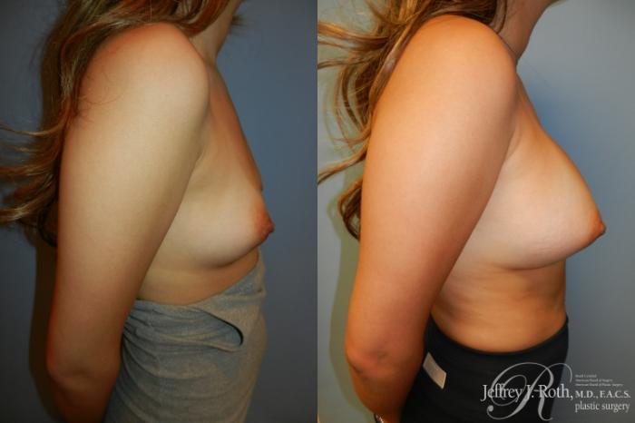 Before & After Breast Augmentation Case 211 Right Side View in Las Vegas, NV