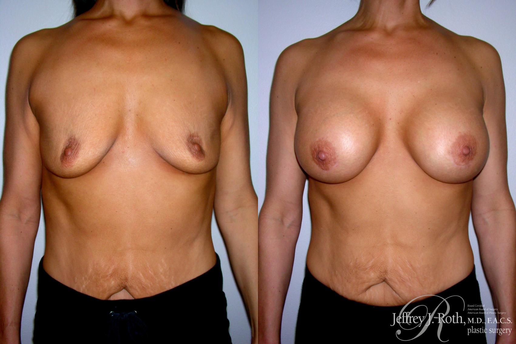 Before & After Breast Augmentation Case 212 Front View in Las Vegas, NV
