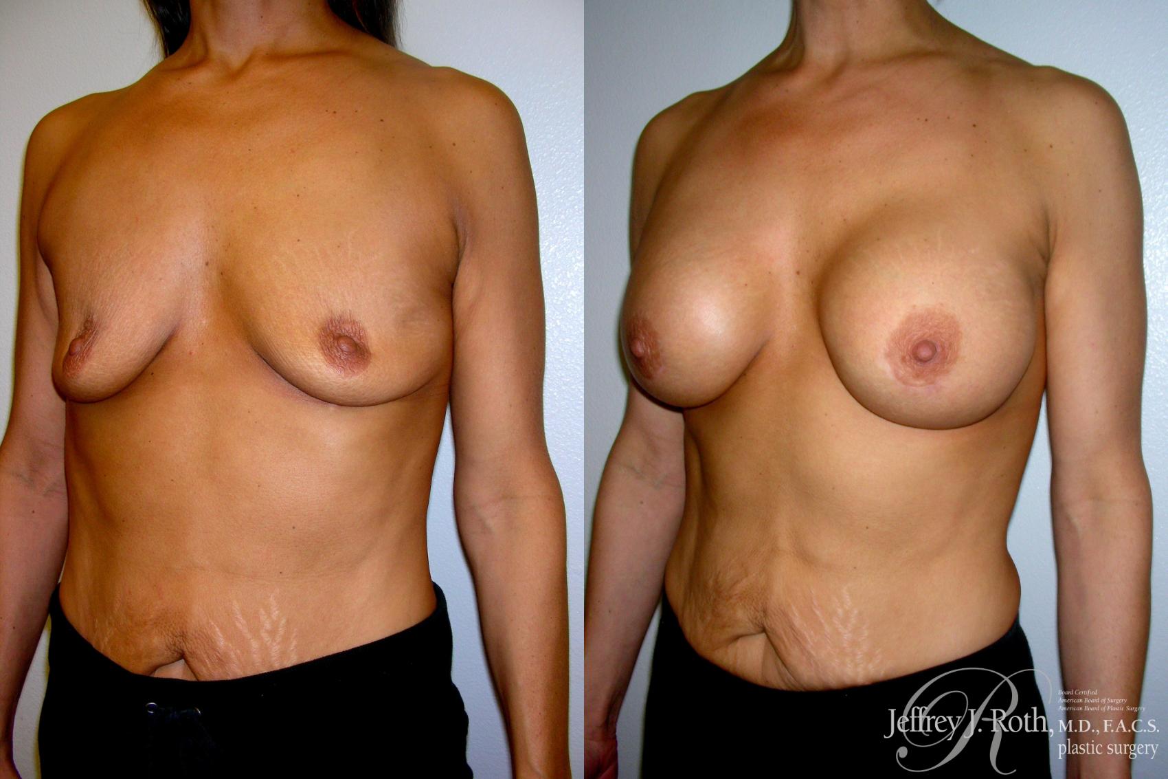 Before & After Breast Augmentation Case 212 Left Oblique View in Las Vegas, NV