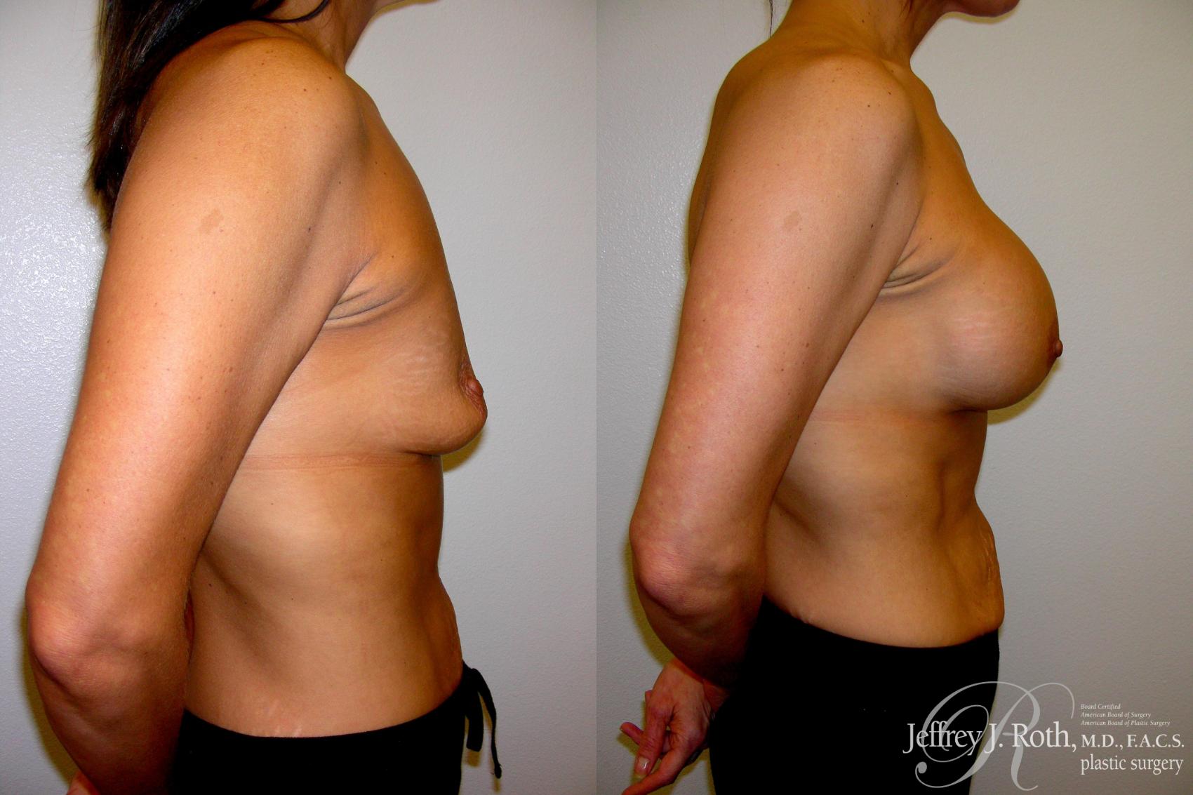 Before & After Breast Augmentation Case 212 Right Side View in Las Vegas, NV