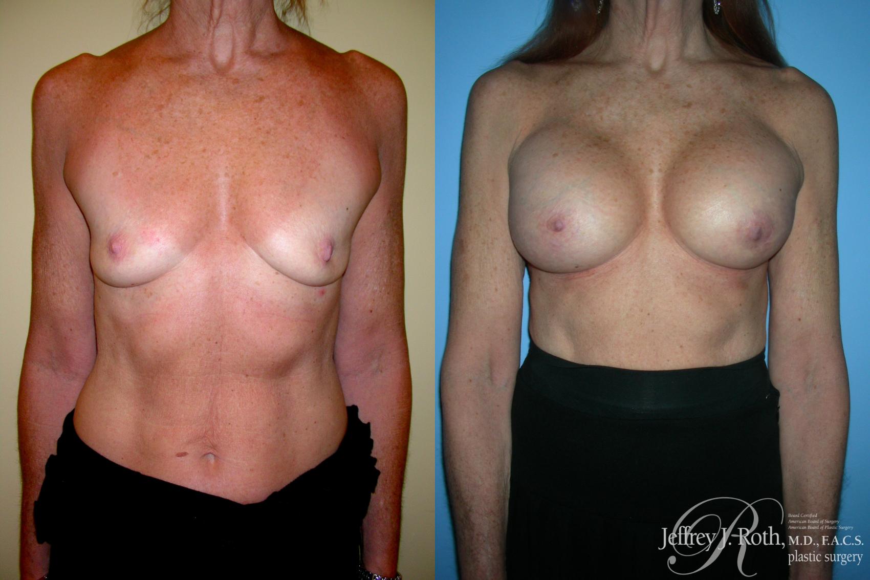 Before & After Breast Augmentation Case 213 Front View in Las Vegas and Henderson, NV