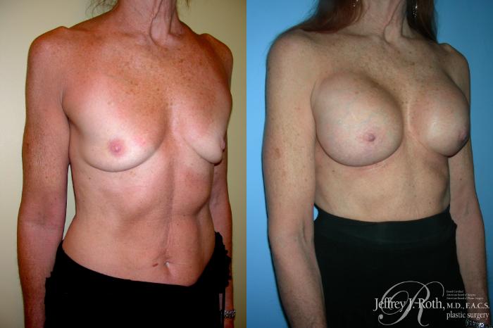 Before & After Breast Augmentation Case 213 Right Oblique View in Las Vegas and Henderson, NV