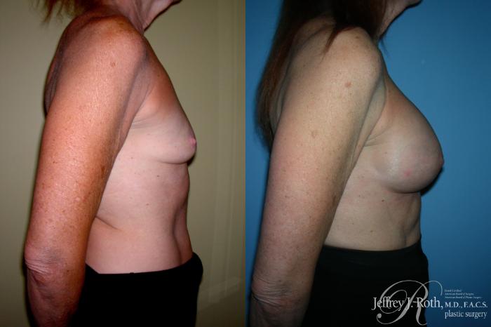 Before & After Breast Augmentation Case 213 Right Side View in Las Vegas and Henderson, NV