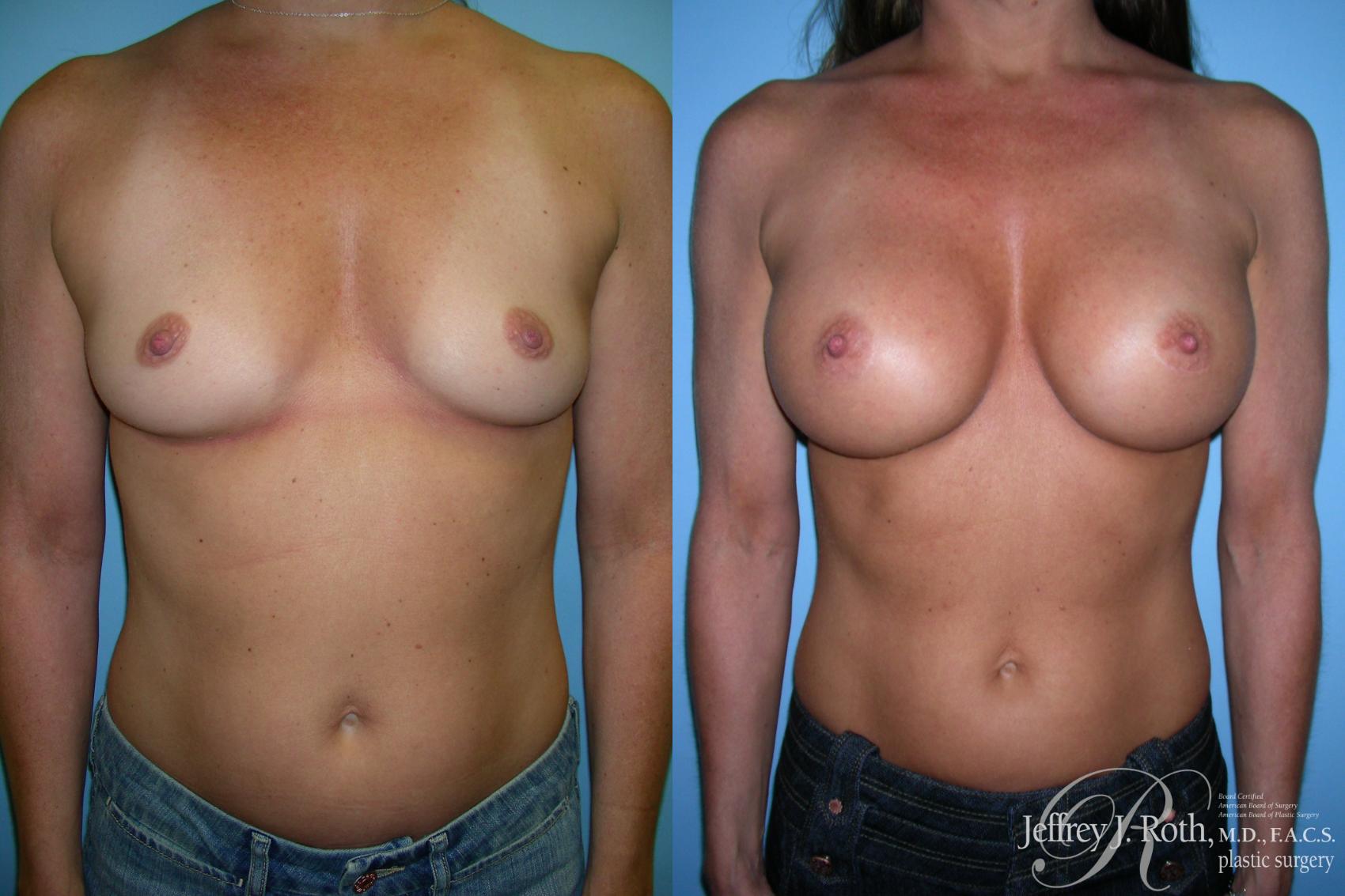 Before & After Breast Augmentation Case 214 Front View in Las Vegas and Henderson, NV