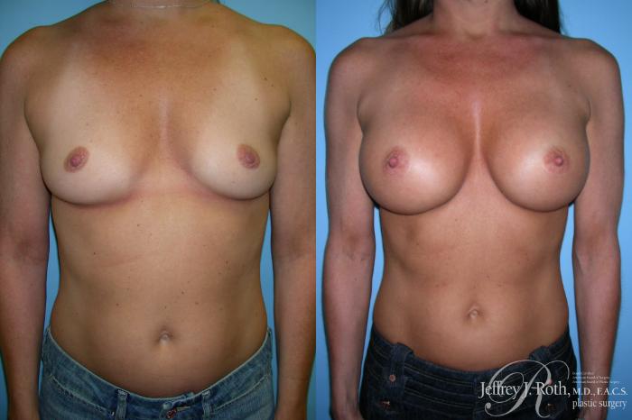 Before & After Breast Augmentation Case 214 Front View in Las Vegas, NV