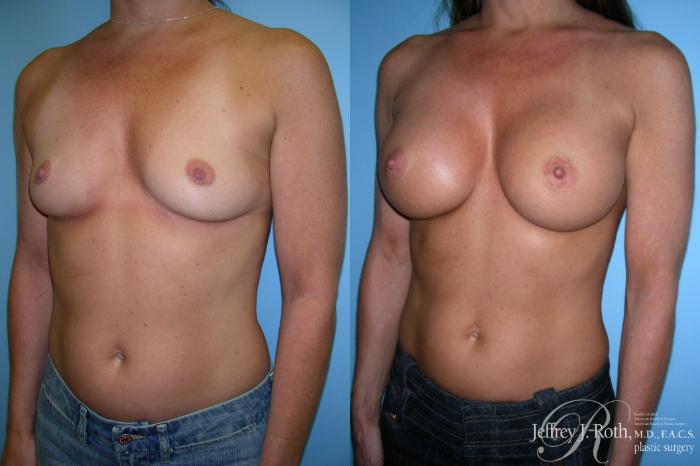 Before & After Breast Augmentation Case 214 Left Oblique View in Las Vegas and Henderson, NV