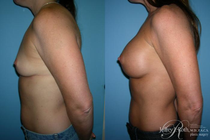 Before & After Breast Augmentation Case 214 Left Side View in Las Vegas and Henderson, NV