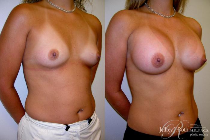 Before & After Breast Augmentation Case 215 Right Oblique View in Las Vegas and Henderson, NV