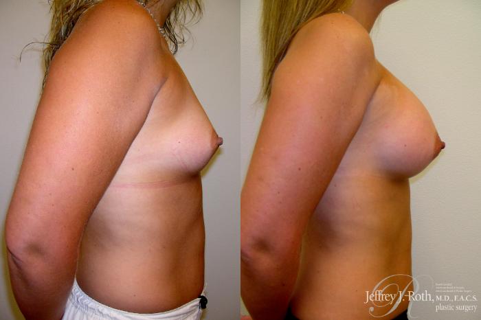 Before & After Breast Augmentation Case 215 Right Side View in Las Vegas and Henderson, NV